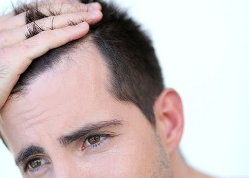 Hair transplantation - آیا کاشت مو دائمی است؟
