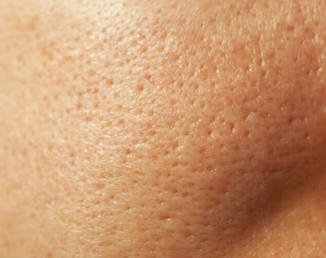 large pores - بهترین راه برای از کوچک کردن منافذ پوست