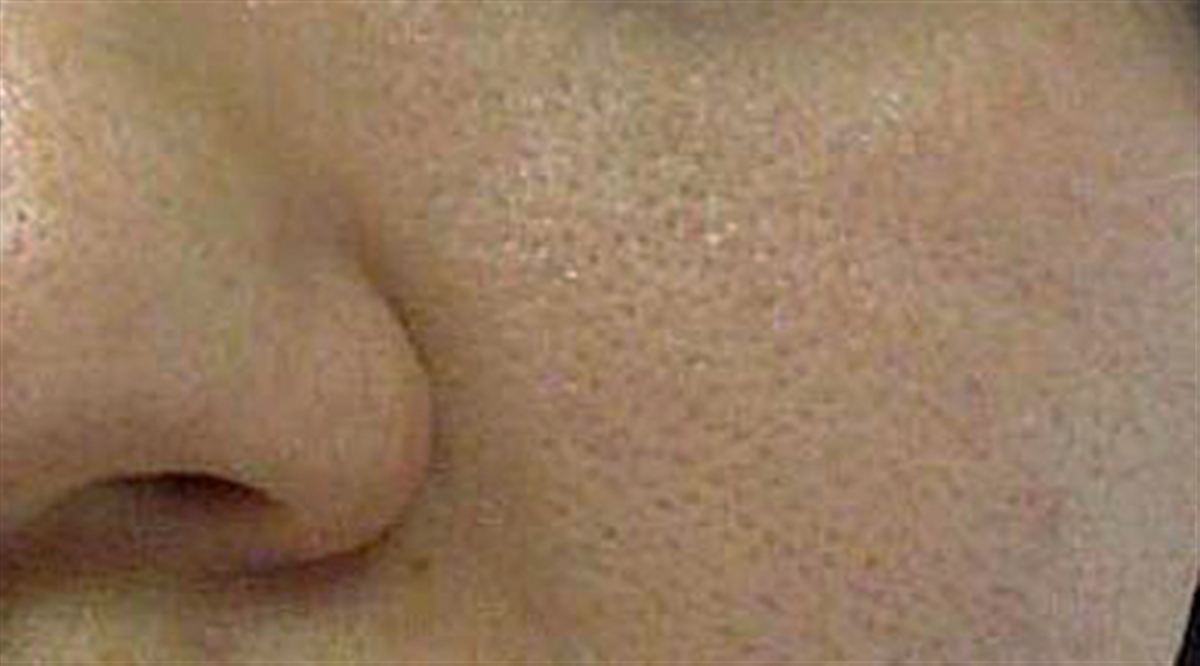 pores  - بهترین راه برای از کوچک کردن منافذ پوست