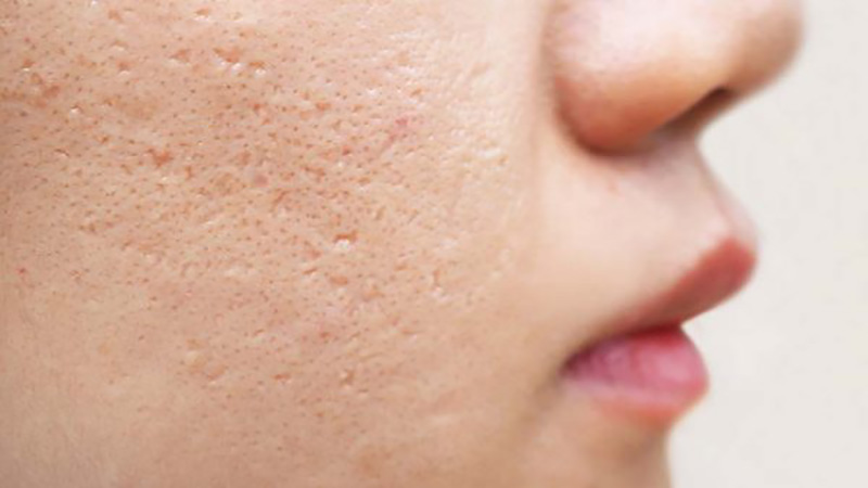 pores. - بهترین راه برای از کوچک کردن منافذ پوست