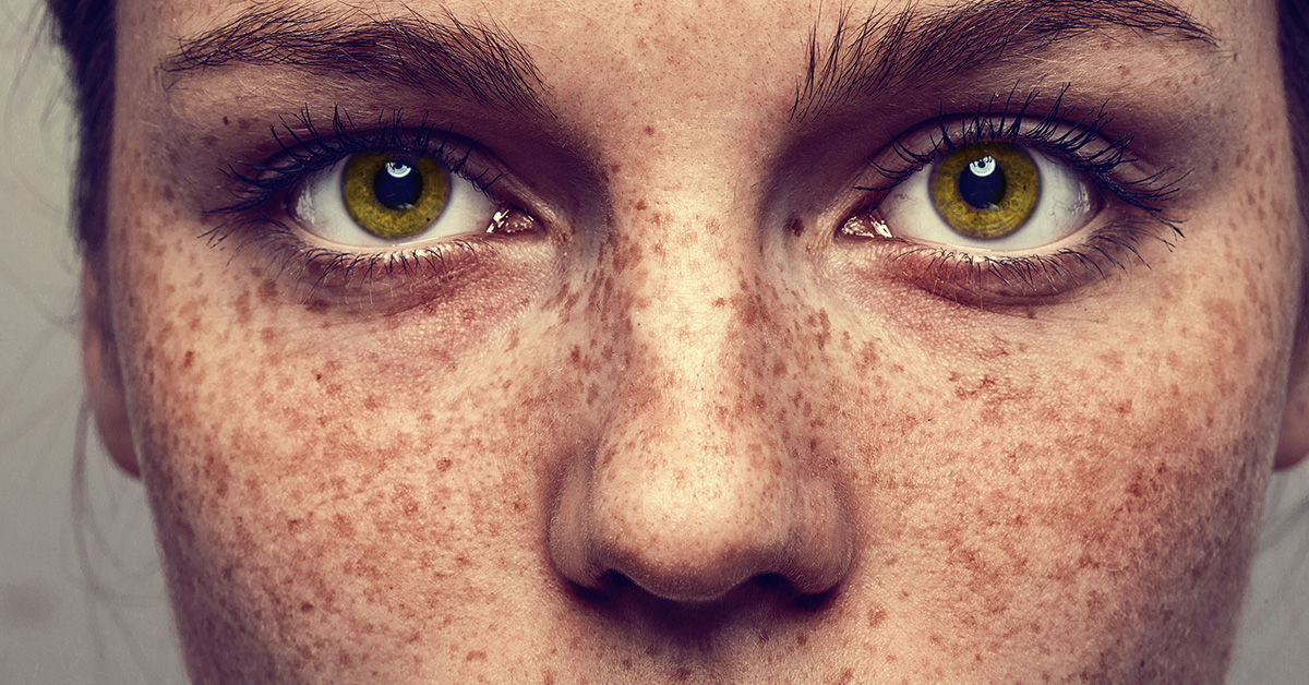 Freckles1 - روش های طبیعی رفع کک و مک