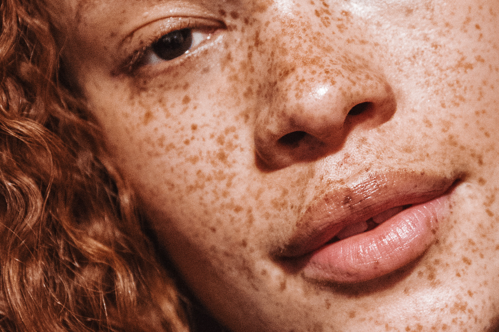 freckles 1 - روش های طبیعی رفع کک و مک